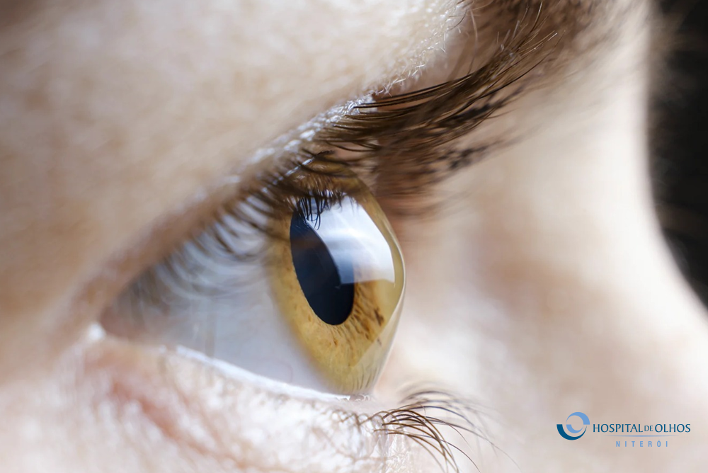 BLOG JUNHO   Ceratocone_ conheça a doença que afeta a córnea e saiba como preservar a visão (2) - H. Olhos Maricá